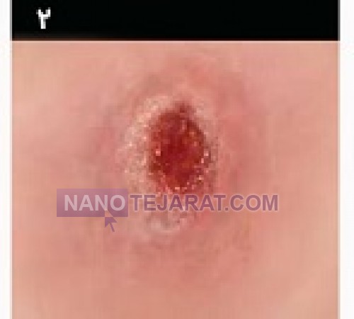 زخم بستر ، عوامل و پیشگیری از آن